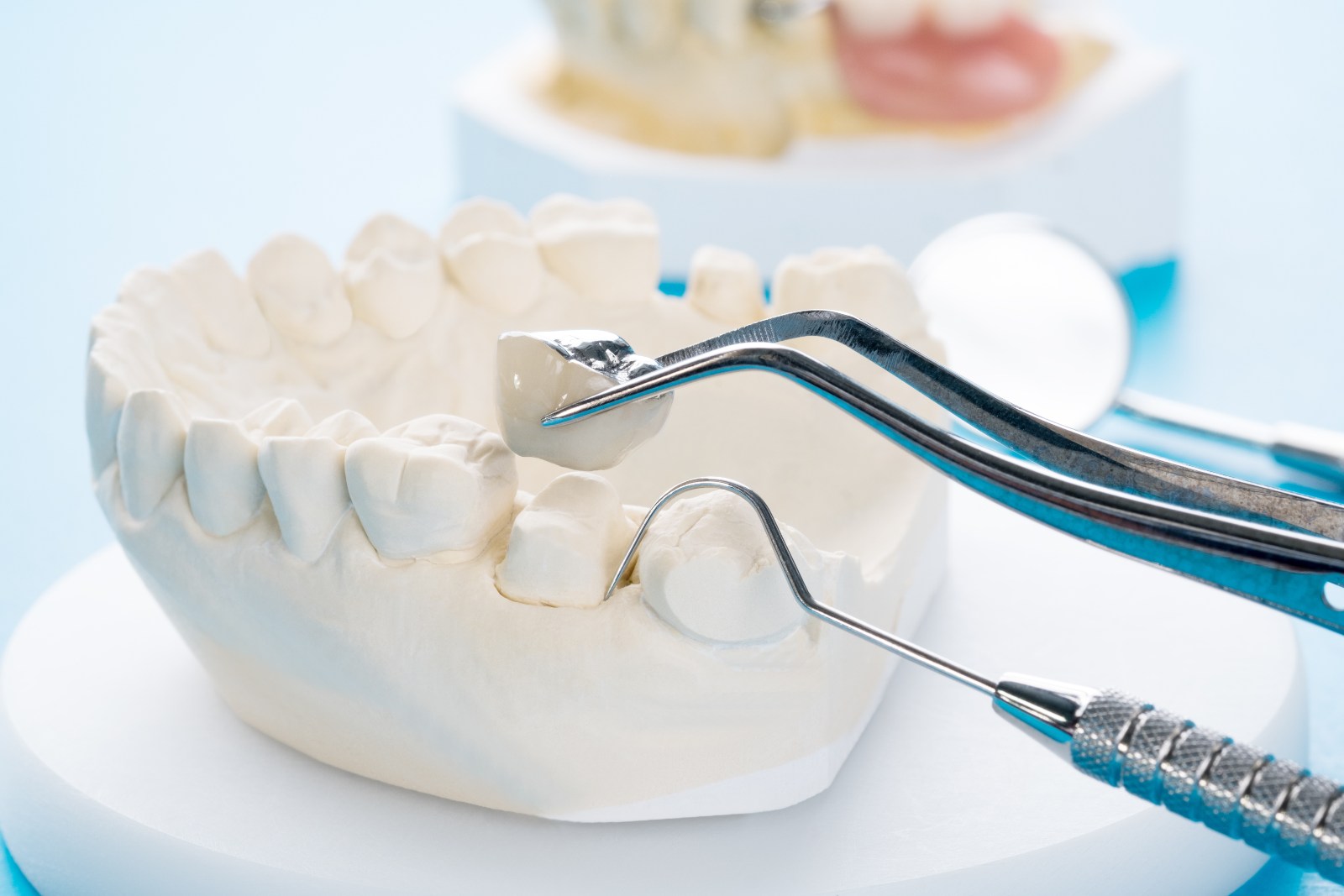dental crowns in Alexandria