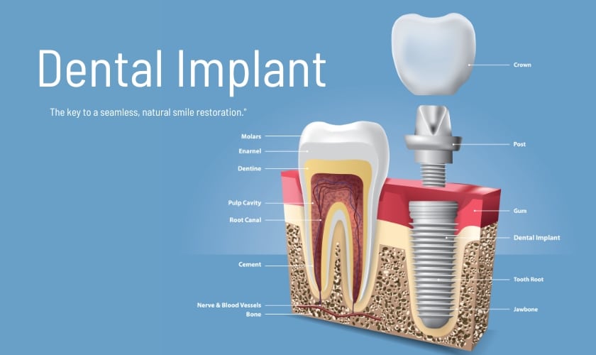 Dental Implant Alexandria | Alexandria Dentist
