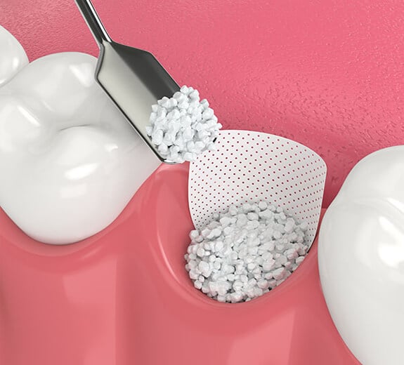 Bone Grafting Treatment in Alexandria, VA | Alexandria Dental Spa