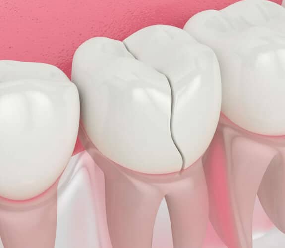 Broken Tooth Treatment in Alexandria, VA | Alexandria Dental Spa