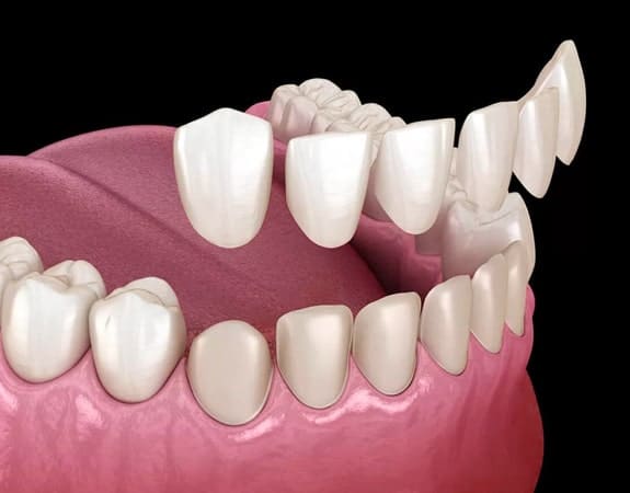 Composite Dental Veneers in Alexandria, VA | Alexandria Dental Spa