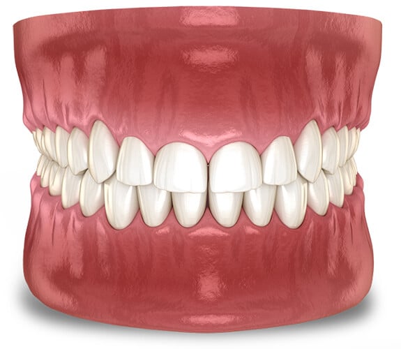 Crown Lengthening in Alexandria, VA | Alexandria Dental Spa