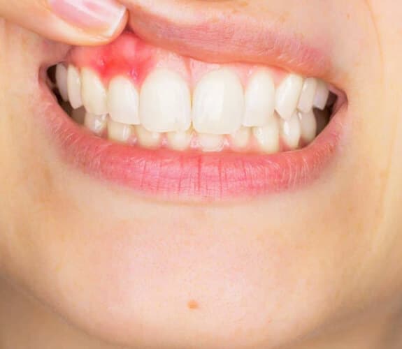 Dental Abscess Treatment in Alexandria, VA | Alexandria Dental Spa