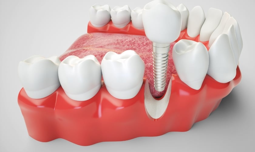 Dental Implants In Alexandria, VA | Alexandria Dental Spa