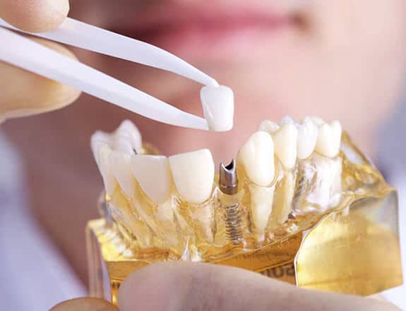 Dental Implants in Alexandria, VA