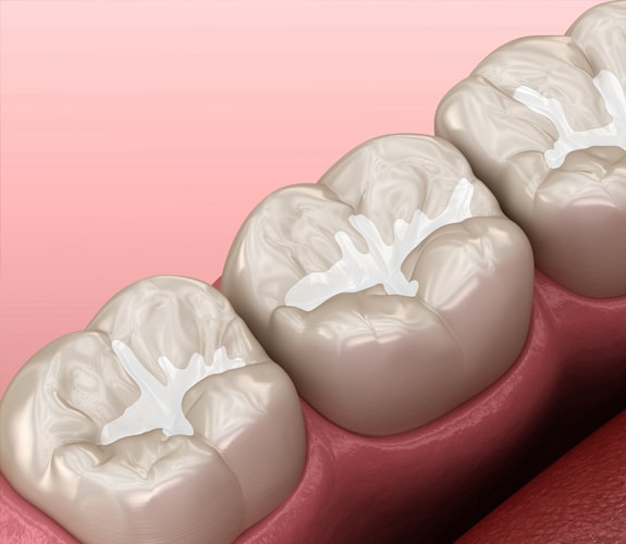 Dental Sealants in Alexandria, VA | Alexandria Dental Spa