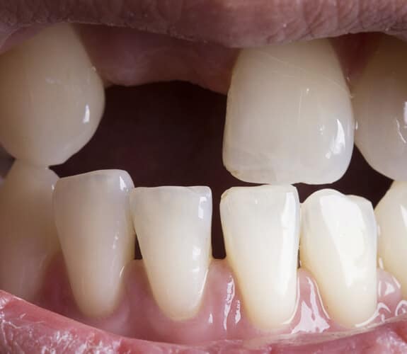 Dental Trauma Treatment in Alexandria, VA