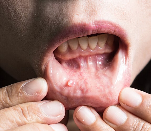 Oral Cancer Screening in Alexandria, VA | Alexandria Dental Spa