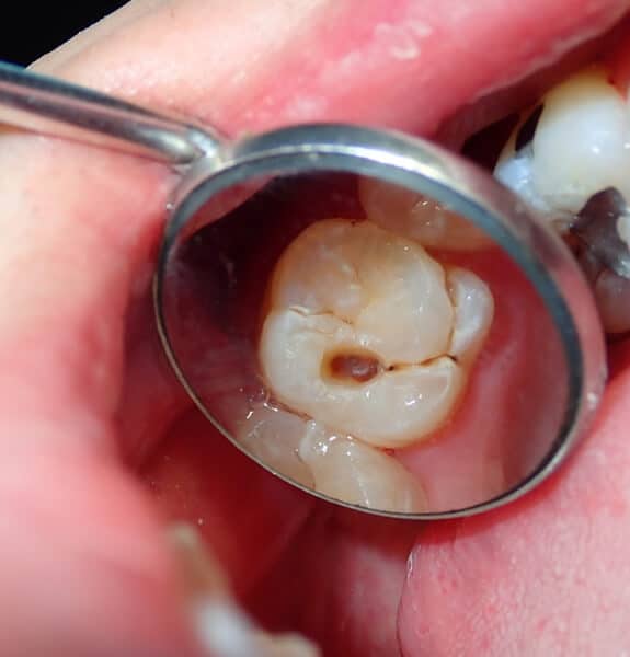 Professional Teeth Cleaning in Alexandria, VA | Alexandria Dental Spa