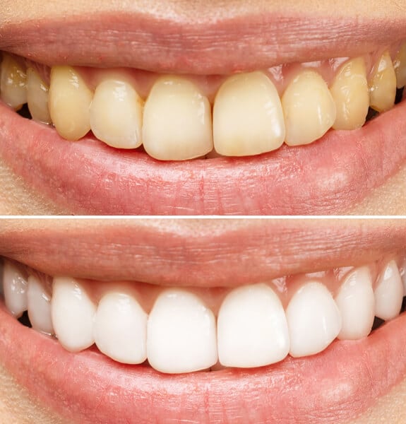 Teeth Whitening Alexandria VA Alexandria Dental Spa