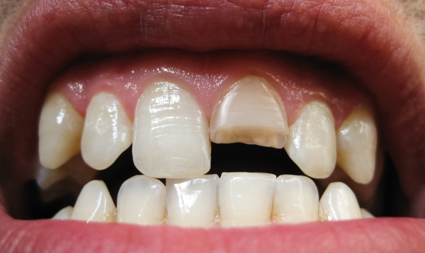How long can I leave a broken tooth in my mouth?