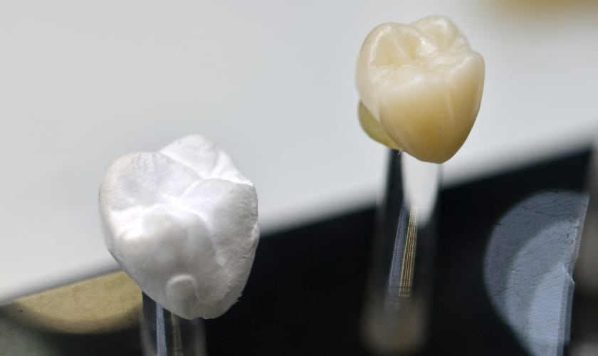 Do I Need A Crown After A Root Canal?