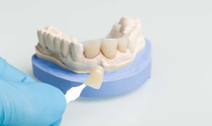 Porcelain Dental Veneers in Alexandria at Alexandria Dental Spa