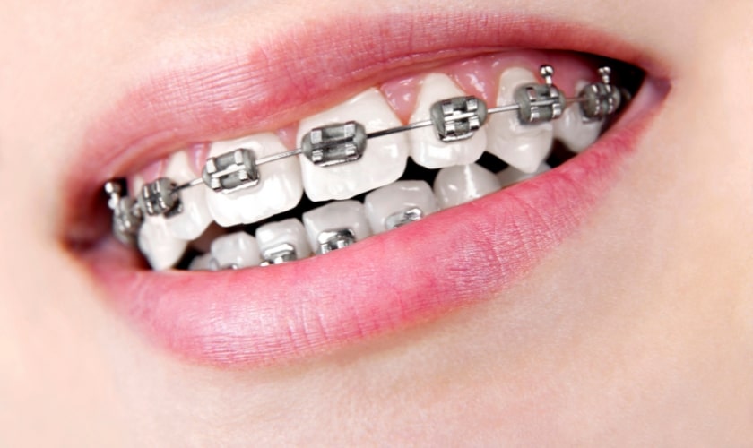 How braces work in Alexandria, VA- Alexandria Dental Spa