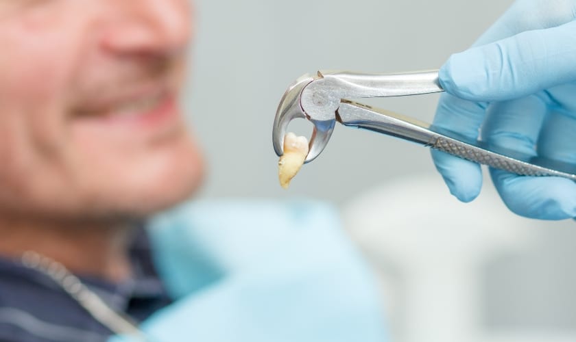 Types of Sedation is used for Tooth extraction in Alexandria at Alexandria Dental Spa