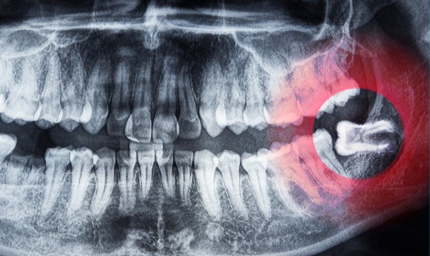This image describe how wisdom teeth removal look like. 