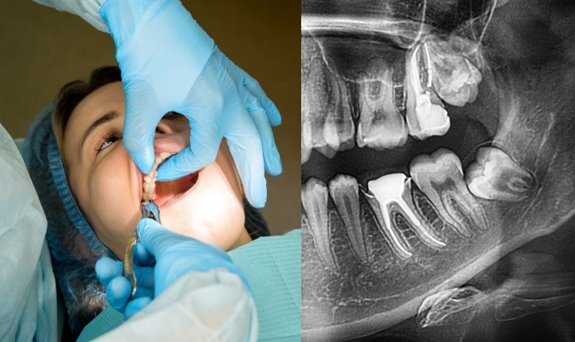 How Long Does Wisdom Teeth Removal Take?