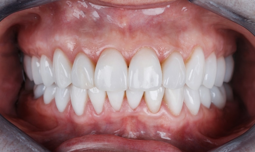 Image of a person's open mouth showing uneven teeth alignment, potentially indicating an uneven bite.