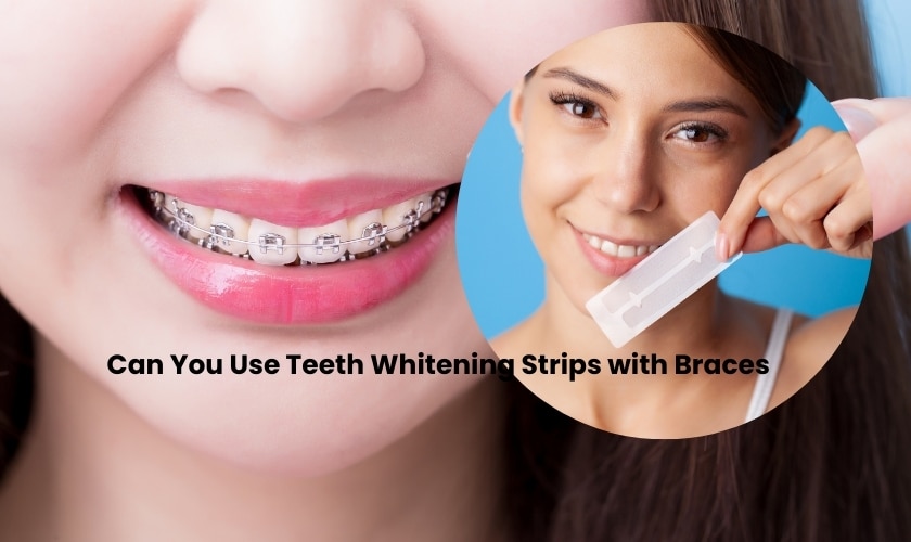 Can You Use Teeth Whitening Strips with Braces? - Alexandria Dental Spa