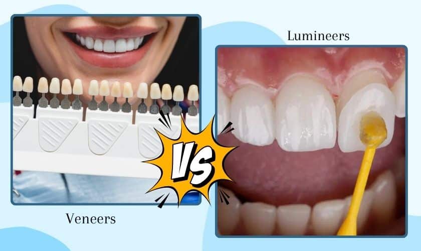 Veneers vs Lumineers