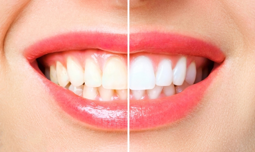 Teeth Whitening For Special Occasions: Get A Dazzling Smile Before Your Big Day
