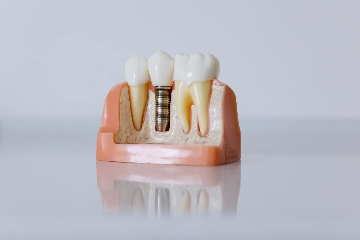 dental implants in Alexandria